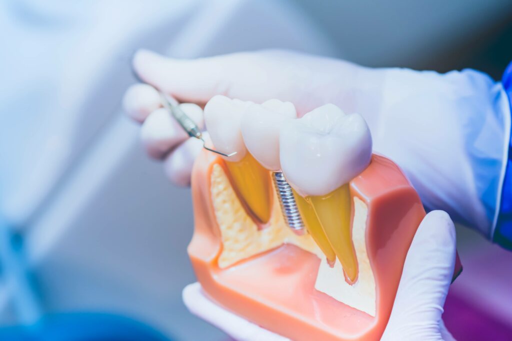 Am I a Candidate for Dental Implants?