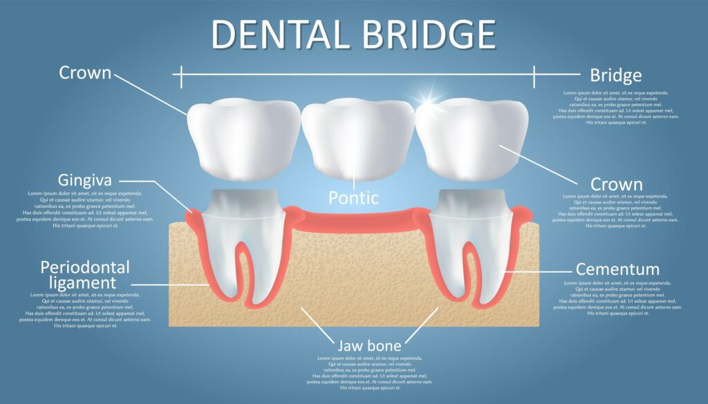 dental bridge procedure