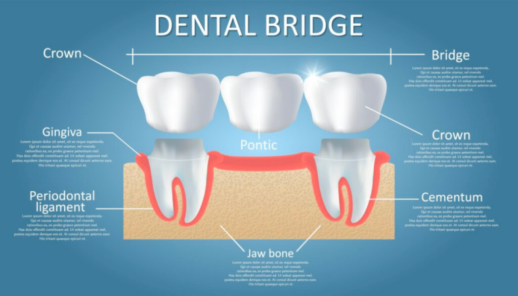 Dental Bridge