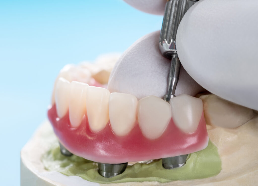 Are Implant-Supported Dentures Removable?