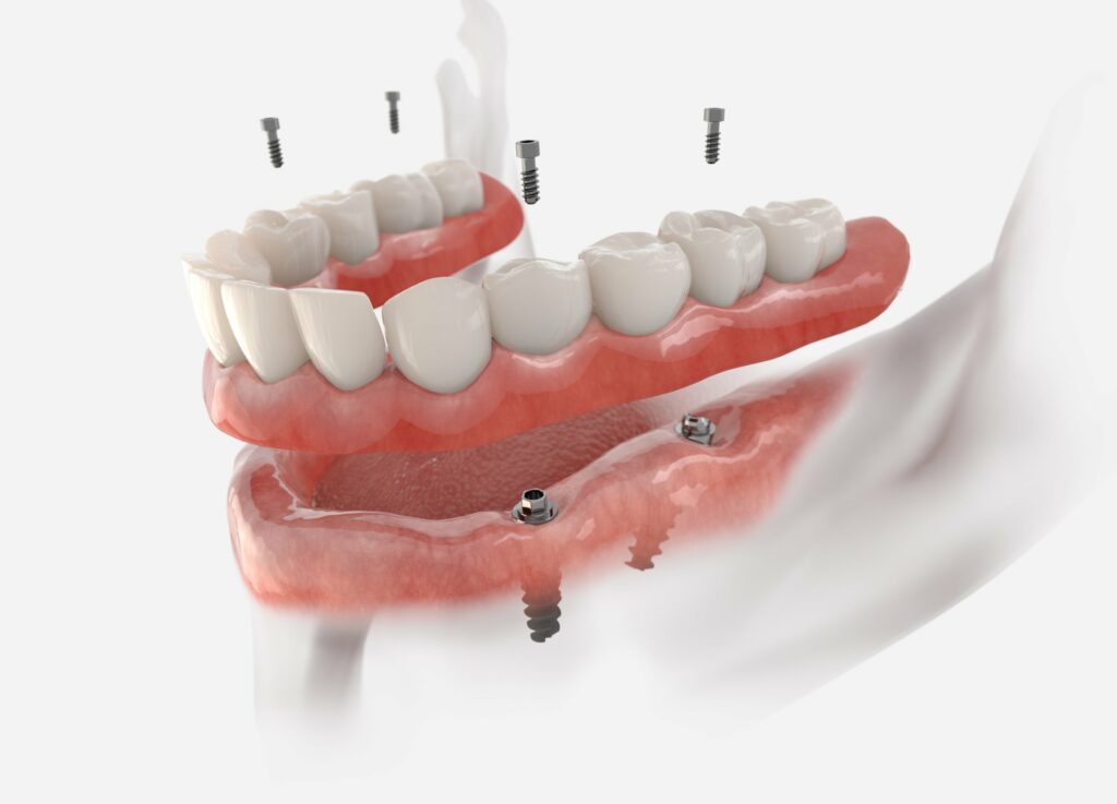 What Are My Options for Replacing a Missing Tooth?