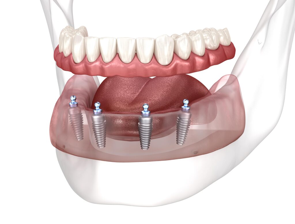 Implant Supported Dentures