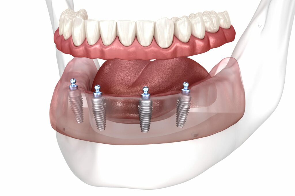 Implant Supported Dentures