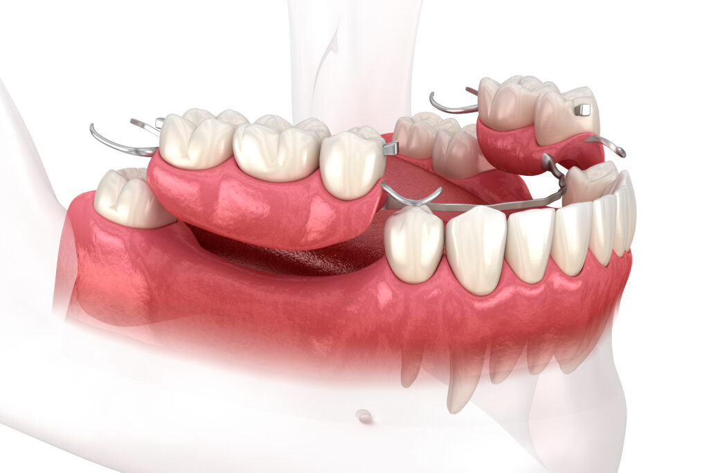 Removable partial denture