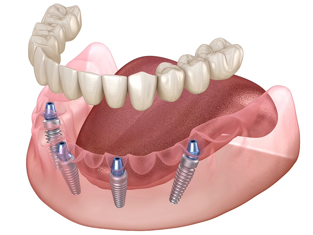 3D model of dentures